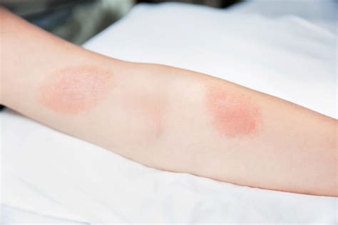 Itchy Blister Rash Pictures Causes And Treatment