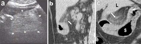 A Initial Transversal Us Views Of The Epigastric Area Showing A 5×4×3