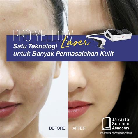 Ketahui Apa Itu Pro Yellow Laser dan Manfaatnya : Jakarta Science Academy