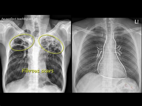 Chest X Ray Tb