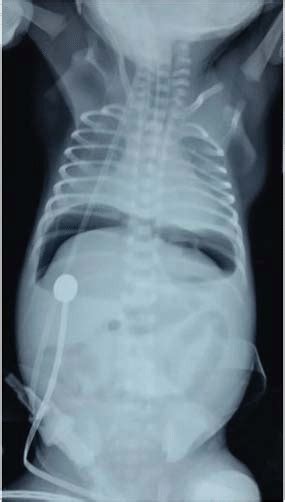 X Ray Abdomen Erect View Air Under Diaphragm Download Scientific Diagram