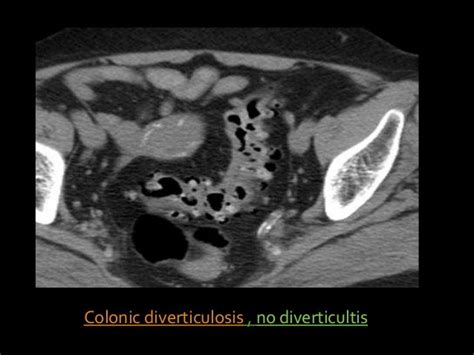 Imaging of Acute Diverticulitis