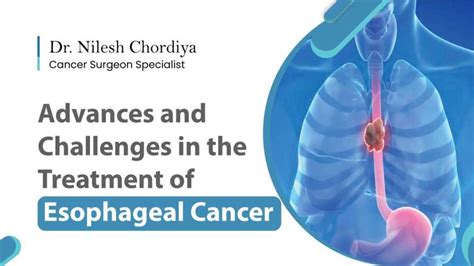 Advances and Challenges in the Treatment of Esophageal Cancer