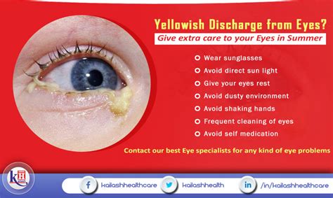 Yellowish Discharge from Eyes? Give Extra care to your Eyes in Summer