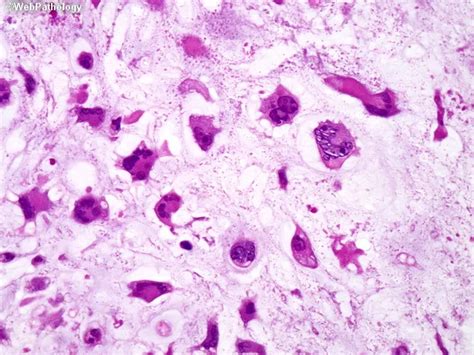 Chondrosarcoma Grade III