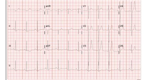 Abnormal EKG? Can anyone make sense of this? : r/EKG