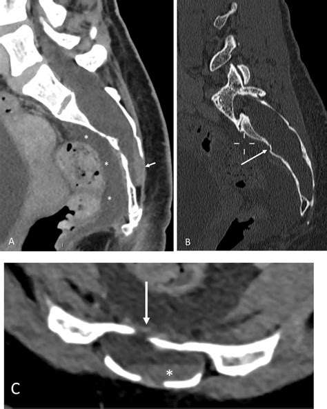 Ct Scan Shows A Hypoattenuating Image Suggestive Of A Sacral Cyst Download Scientific Diagram