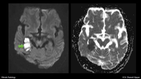 Occipital Lobe Stroke