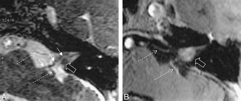 Assessment Of Internal Auditory Canal Tumors A Comparison Of Contrast