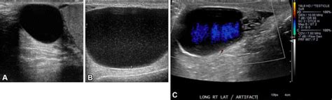 Gamut Of Extratesticular Scrotal Masses Anatomic Approach To