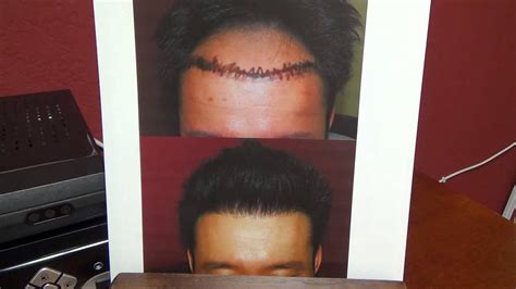 Follicular Unit Extraction Fue Less Scar Hairline Treatment Hair Transplant Diep Mhtaclinic