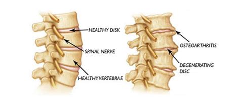 The Best Treatment for Arthritis In the Neck — Solving Pain With ...