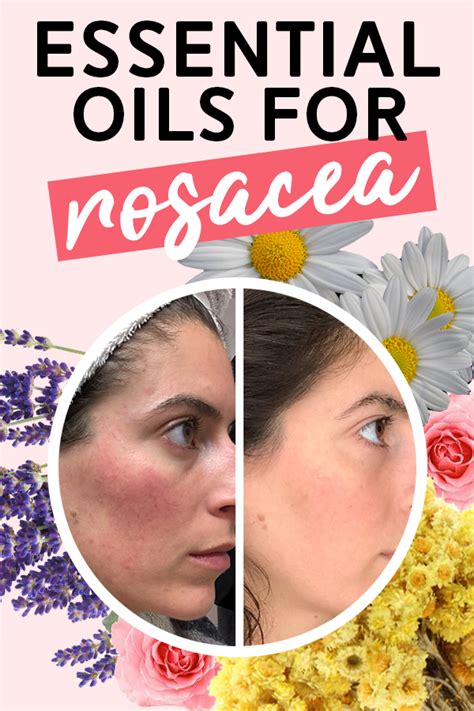 10 Home Remedies For Rosacea That Prevent Redness On The Skin Artofit