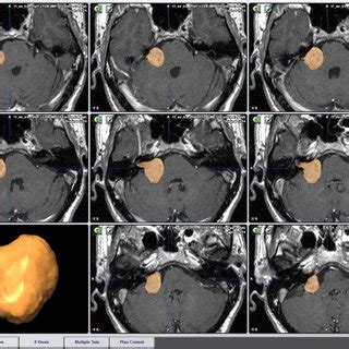 The Smartbrush Function Iplan Brainlab Elements Provide An Interactive