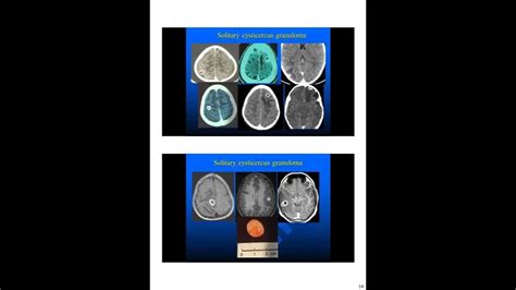 Neurocysticercosis Youtube