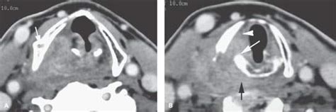 Hypopharynx Malignant Tumors Radiology Key