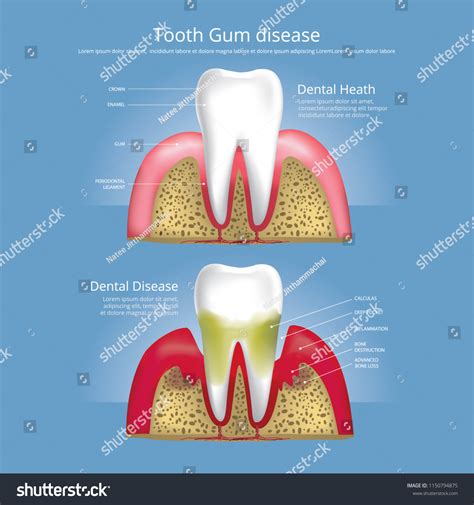 Human Teeth Stages Of Gum Disease Vector Royalty Free Stock Vector