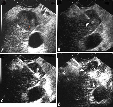 Eus Guided Nd Yag Laser Ablation Of A Hepatocellular Carcinoma In The