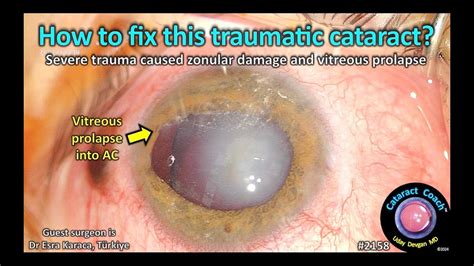 CataractCoach 2158 How To Fix This Traumatic Cataract With Vitreous