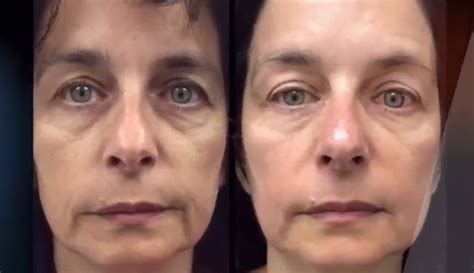 Before And After With Eminence Organics Eminence Organic Skin Care