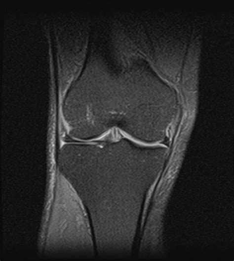 Prepatellar Bursitis Image