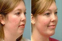 Fat Melting Injections In Dubai Abu Dhabi Sharjah Fat Dissolving