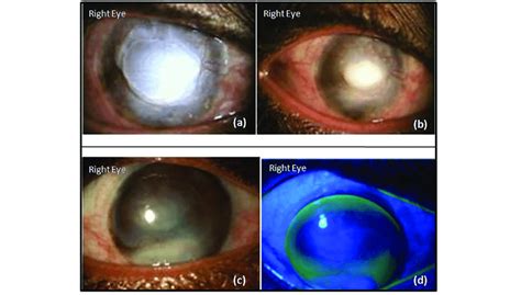 acute corneal hydrops grade   resolving moorens ulcer