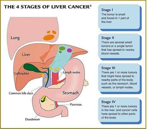 Stages Of Liver Cancer Medizzy