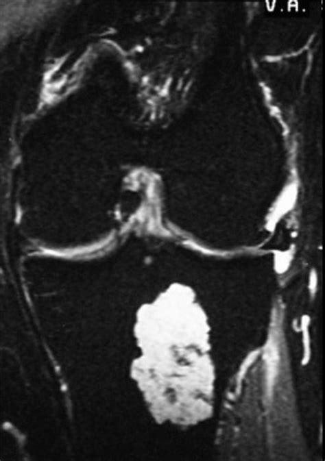 Chondrosarcoma x ray - wikidoc