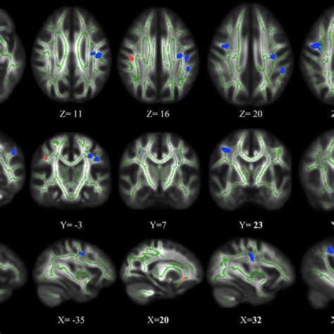 Overlapping WM Areas Between DTI Measures FA AD And RD In ASPD