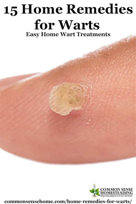 15 Home Remedies For Warts Easy Home Wart Treatments