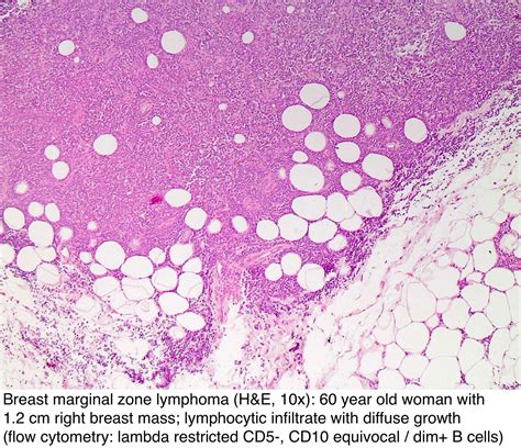 Pathology Outlines Lymphoma