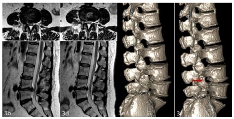 SciELO Brasil EFFICACY OF FULL ENDOSCOPIC INTERLAMINAR AND