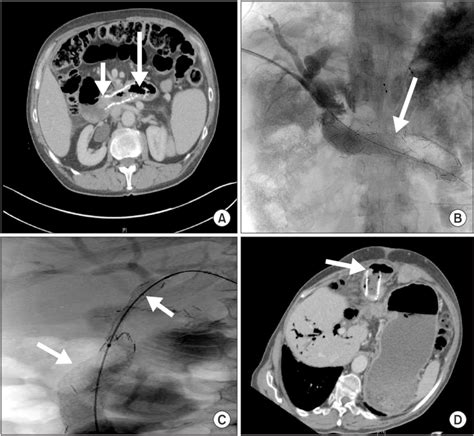 Stent complications. (A) Computed tomography (CT) 9 months post... | Download Scientific Diagram