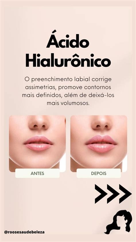 Alguns Benefícios De Preenchimento Labial Com Ácido Hialurônico