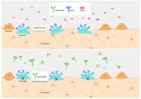 First denosumab biosimilar approved by FDA - Mabion