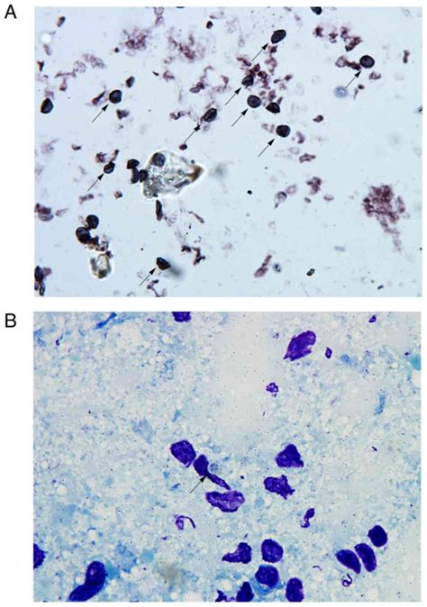 Role Of Pneumocystis Jirovecii Infection In Chronic Obstructive Pulmonary Disease Progression In