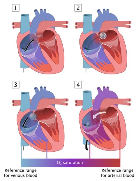 Congenital Heart Defects Diagrams