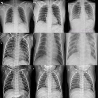 Chest X-rays from COVID-19 Radiography Database: COVID-19 (Row 1),... | Download Scientific Diagram