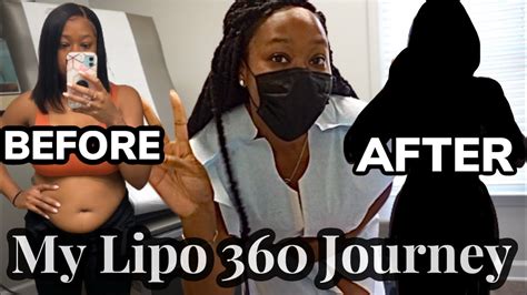 Surgery Vlog I Got Awake Lipo 360 😳 Experiencing Complications Before And After Youtube