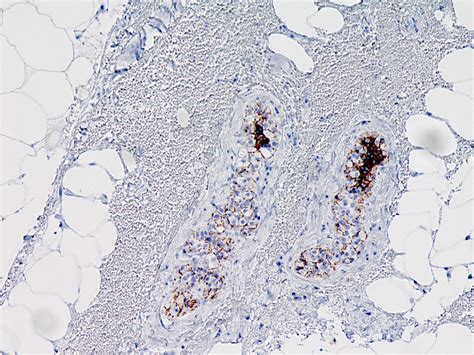 Pathology Outlines Atypical Lobular Hyperplasia