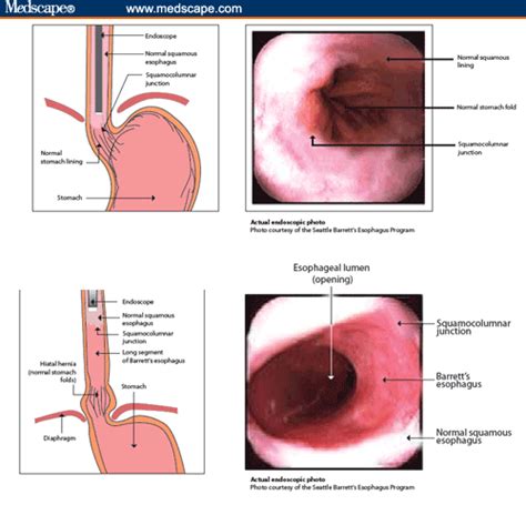 Gastroesophageal Reflux Disease Gerd Diagnosis A Primary Care Case Study