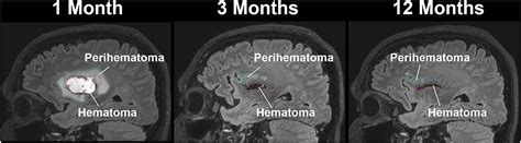 Frontiers Longitudinal Quantitative Multimodal Mri Evaluation Of Patients With Intracerebral