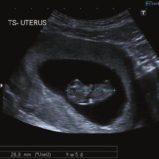 Longitudinal Transvaginal Ultrasound Image Of An Early Intrauterine