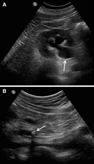 a Ultrasound demonstrating right moderate hydronephrosis and ...