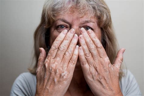 Middle-age Caucasian Woman Show Her Hands with Problem Dermatological Called Vitiligo Stock ...