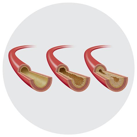 Understanding Peripheral Arterial Disease Peripheral Intervention