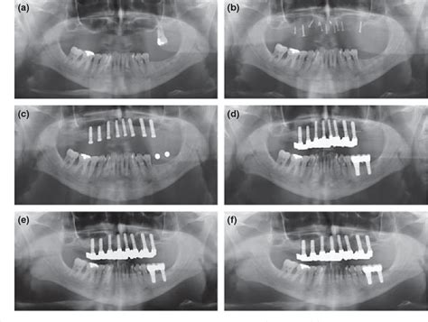 Figure 1 From Long Term Changes In Graft Height After Maxillary Sinus