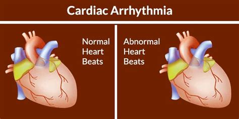 What Is Cardiac Arrhythmia | Heart Rhythm Disorder | Cardiac arrhythmia ...