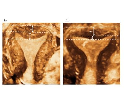 Eshre Esge Female Genital Tract Anomalies Classification Systemthe